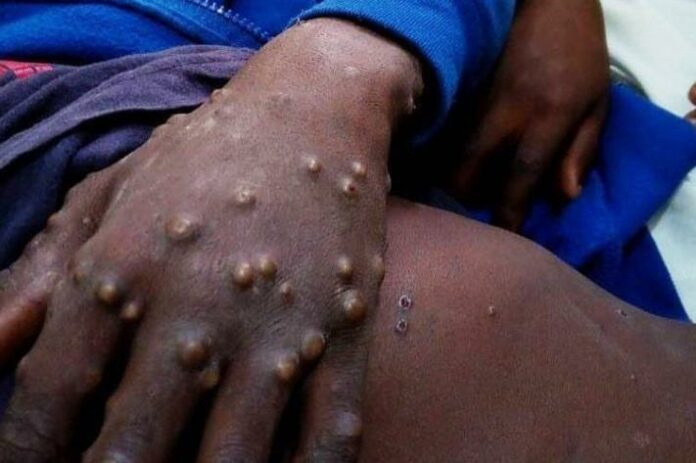 maniema: deux morts sur 250 cas de monkey pox recensés