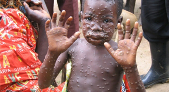 Kwilu: Une épidémie de Monkeypox fait rage